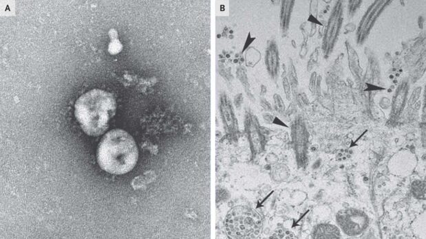 Cowan and Haberland Illuminate the Dogma of Virus Denialism 15 Electron miscroscopy images of SARS-CoV-2 virions from Na Zh et al., New England Journal of Medicine, February 2020.